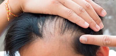  Никотиновая кислота от выпадения волос