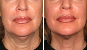 //cdn.optipic.io/site-106815/issues/evolyutsiya-rf-tekhnologiy-ot-neinvazivnykh-k-invazivnym/rf3.jpg //cdn.optipic.io/site-106815/issues/evolyutsiya-rf-tekhnologiy-ot-neinvazivnykh-k-invazivnym/rf3.jpg