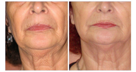 //cdn.optipic.io/site-106815/issues/evolyutsiya-rf-tekhnologiy-ot-neinvazivnykh-k-invazivnym/rf2.jpg //cdn.optipic.io/site-106815/issues/evolyutsiya-rf-tekhnologiy-ot-neinvazivnykh-k-invazivnym/rf2.jpg