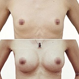 Увеличение груди 