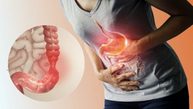 La sindrome del colon irritabile: un segreto da condividere