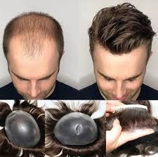 //cdn.optipic.io/site-102379/blog/kakie-strizhki-my-ne-delaem/nakladnye-volosy-sistema-zameshcheniya-volos/images (23).jpg