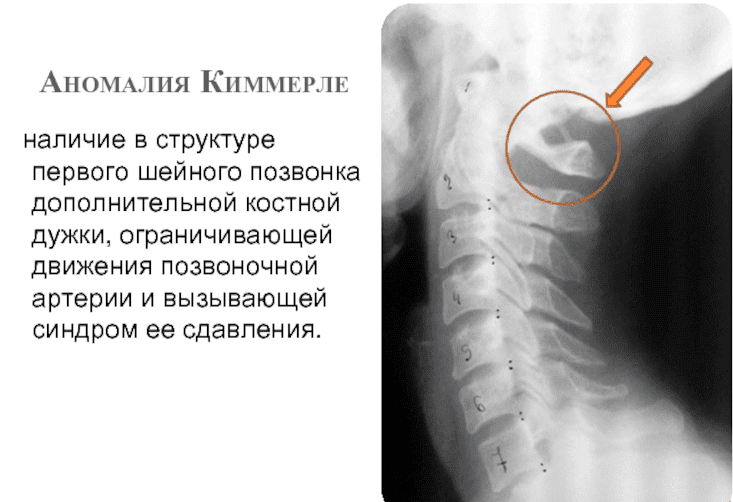 Аномалия киммерли фото