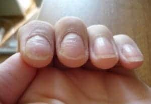 Почему ногти крошатся: основные причины и способы укрепления