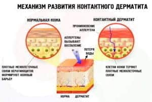Симптоматика дерматита