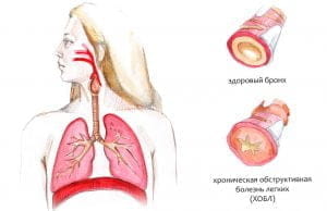 Методы устранения и способы профилактики ХОБЛ