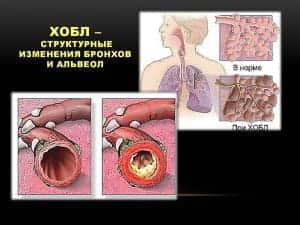 Симптомы обструктивной болезни легких