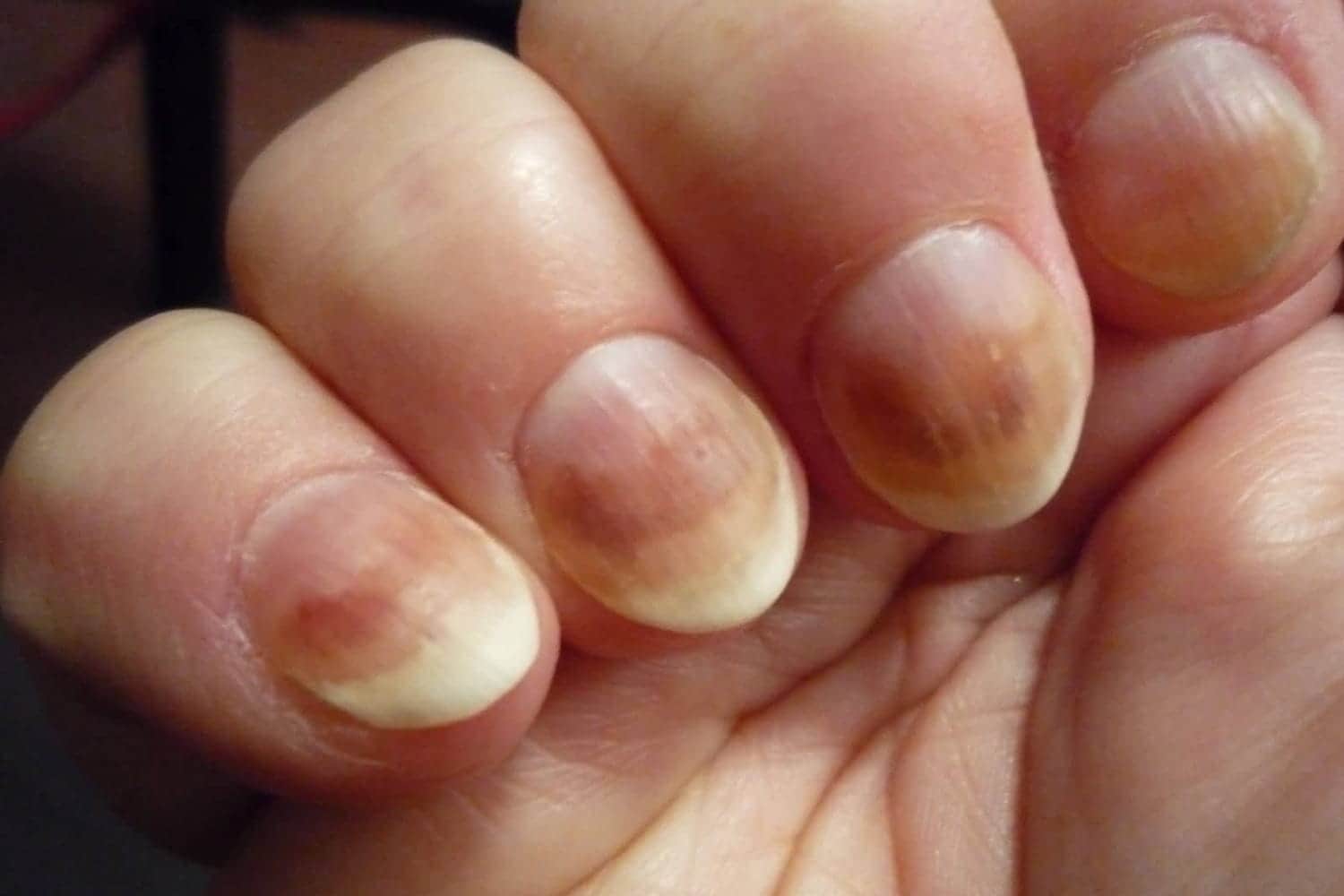 Грибок ногтей | Лечение грибка ногтей в med