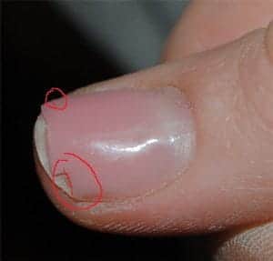 Трещины на ногтях: причины, виды и лечение