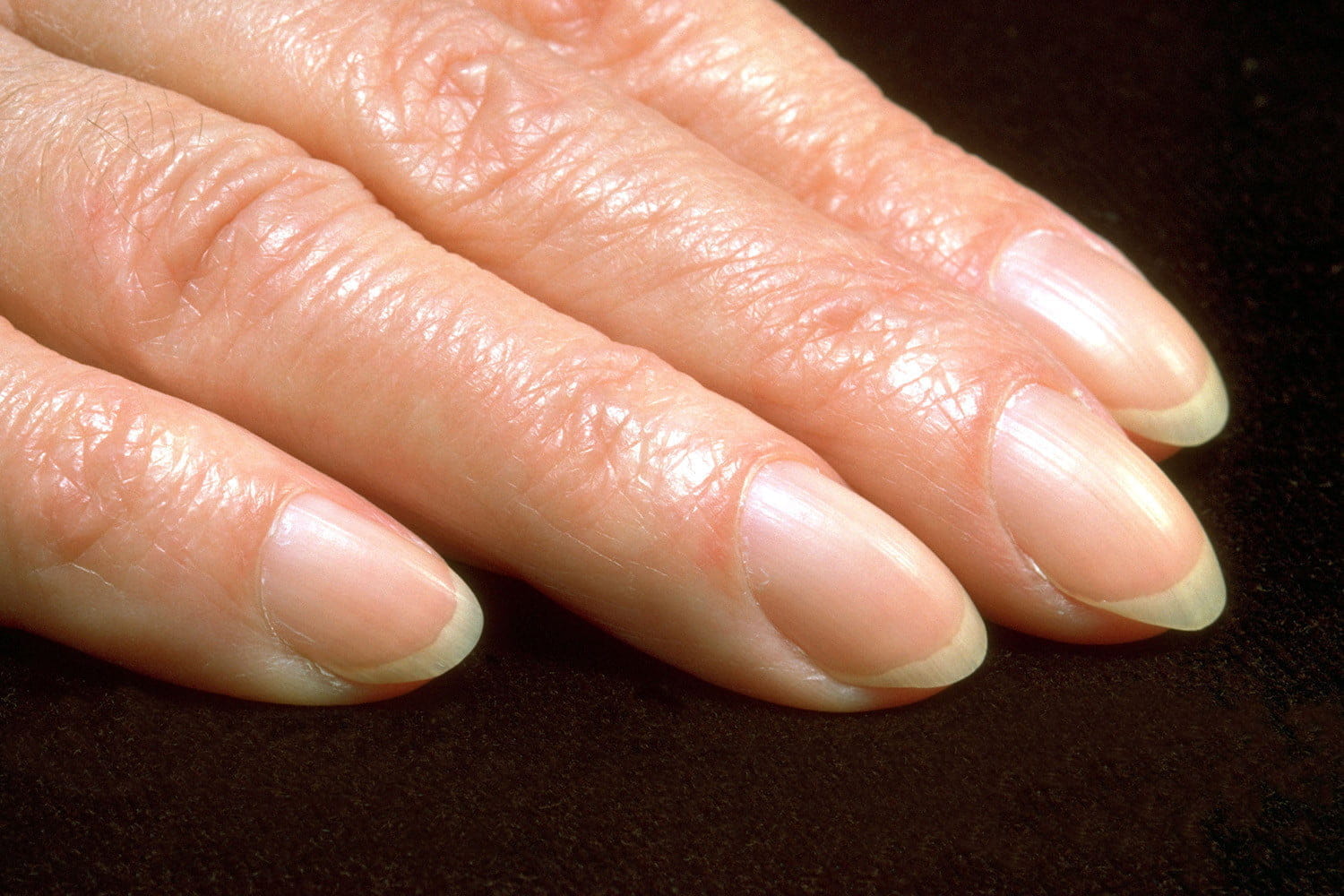 Что такое онихогрифоз, или когтеобразные ногти?