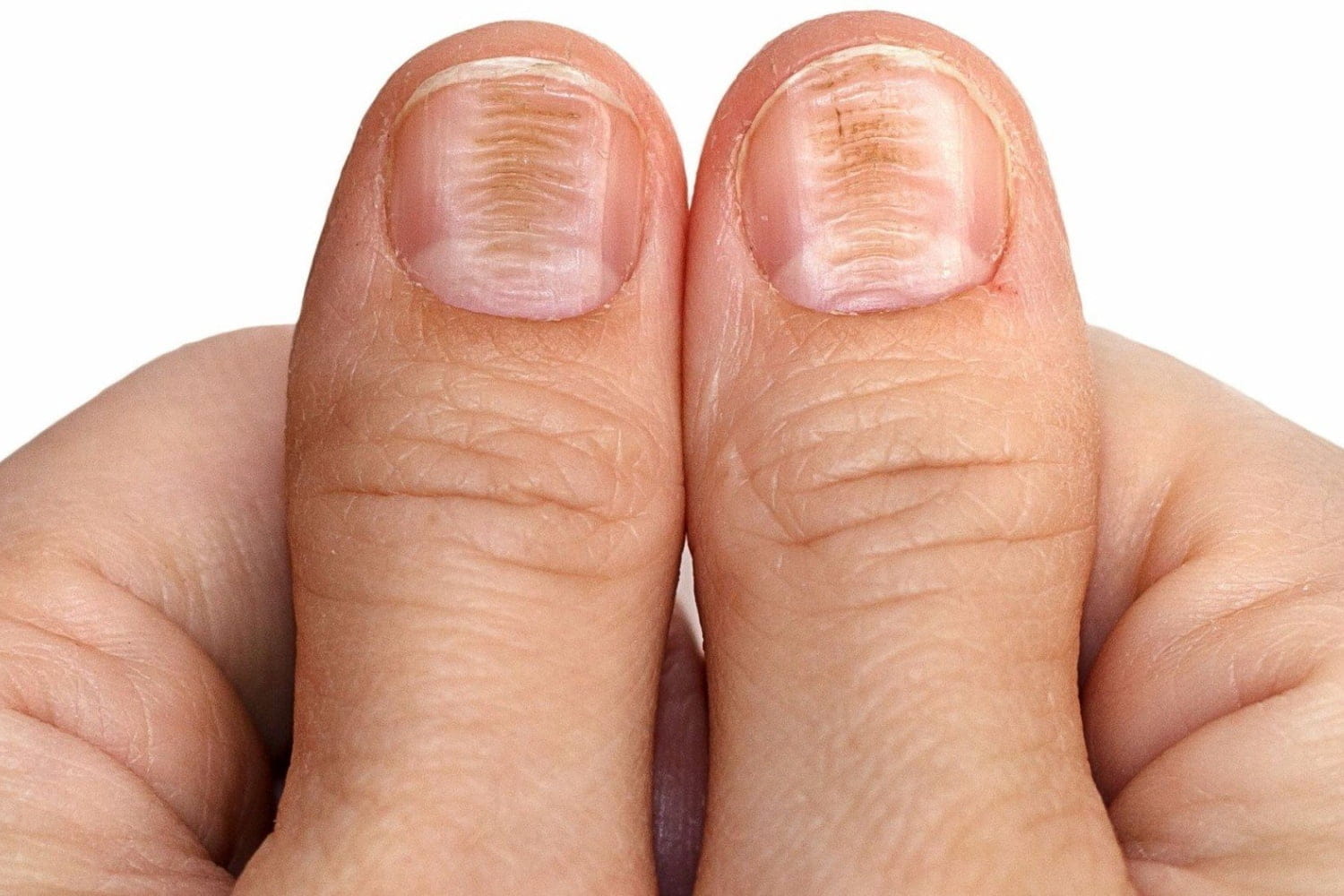 Платонихия – почему ногти становятся плоскими и как этого избежать