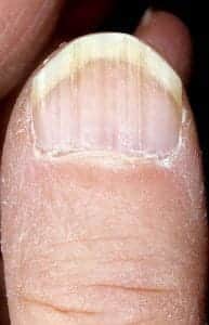 Ониходистрофия (дистрофия ногтей)