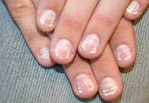 Белые пятна на ногтях: причины и лечение