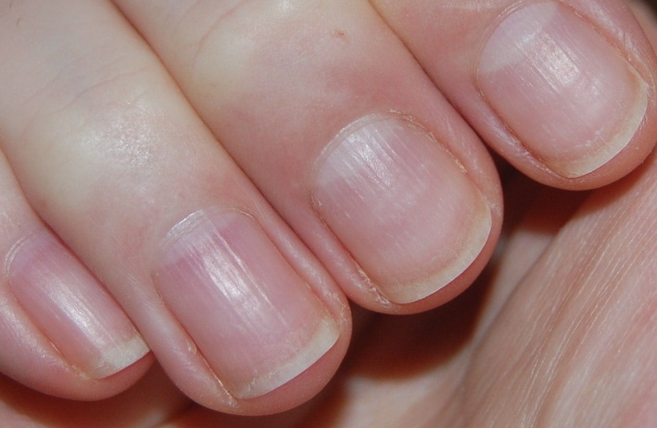 Почему ногти становятся волнистыми: 6 основных причин