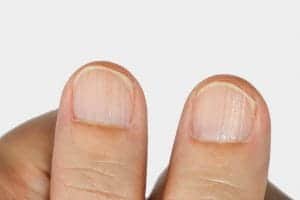 Почему ногти на руках ребристые: причины и лечение