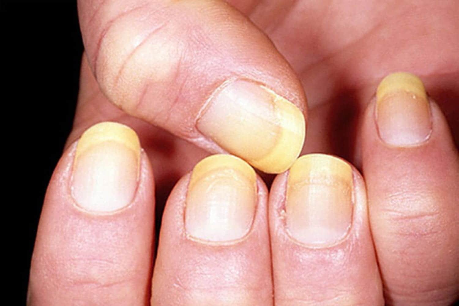 Лечение почерневших ногтей