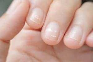Белые пятна ногтей