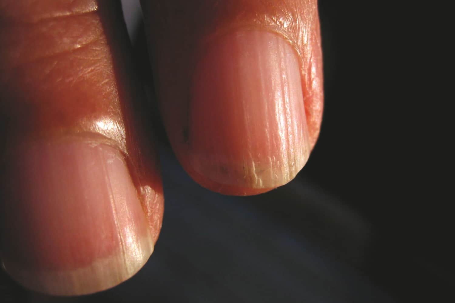 Почему трескаются ногти и кожа вокруг ногтей – причины, лечение и  профилактика