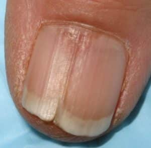 Болезни ногтей – лечение в Кривом Роге