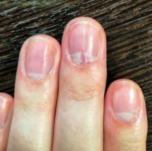 Что такое гипонихий и почему разрастается кожа под ногтями