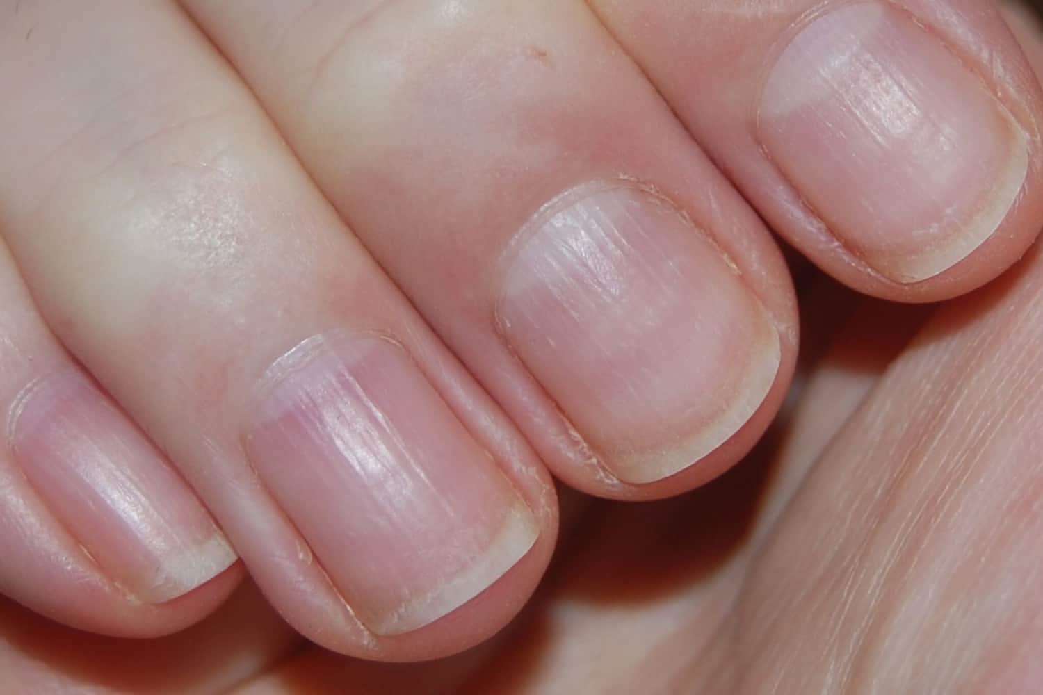 Продольные борозды на ногтях рук и ног – симптомы, причины, лечение и  профилактика