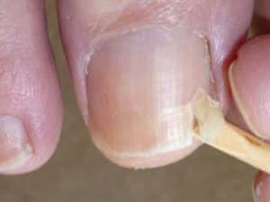 Лечение онихолизиса ногтей