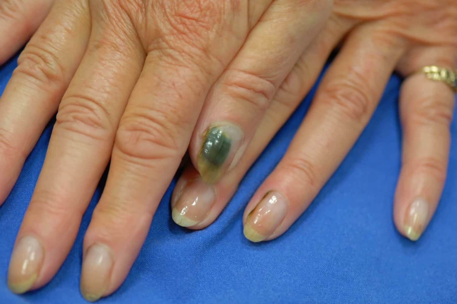 Зеленые ногти: симптомы, причины и лечение