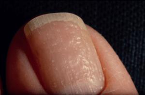 Псориаз ногтей : симптомы, причины появления и методы лечения (Тайтл)