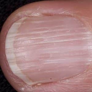 Признаки дистрофии ногтя