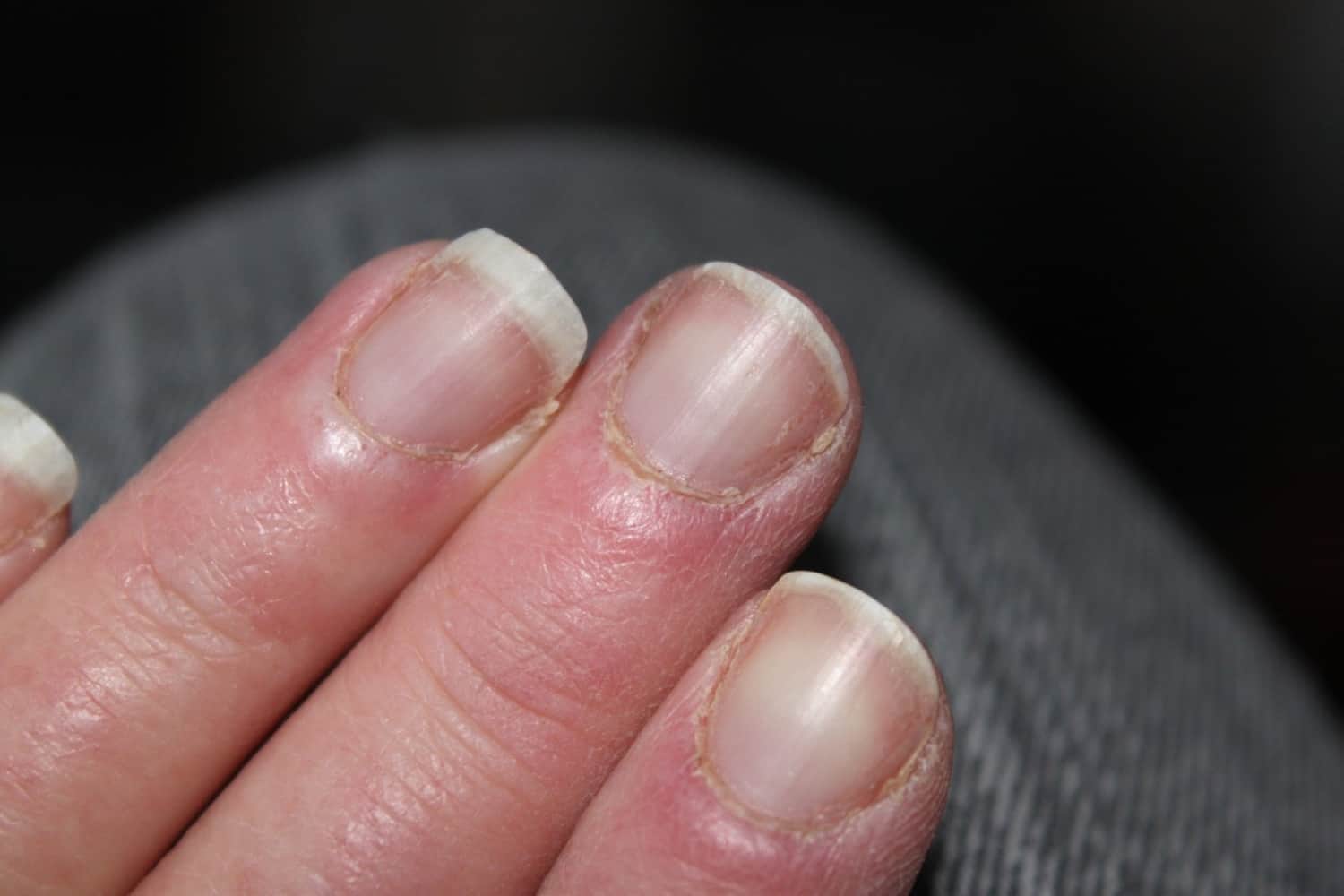 Основные причины поломки и расслоения ногтевой пластины