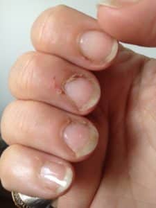 Причины сухой кожи вокруг ногтей на руках