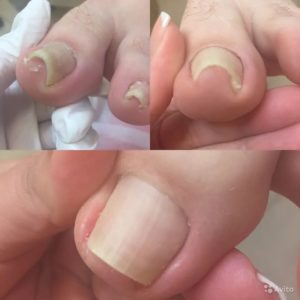 Как выровнять ногти от скручивания?