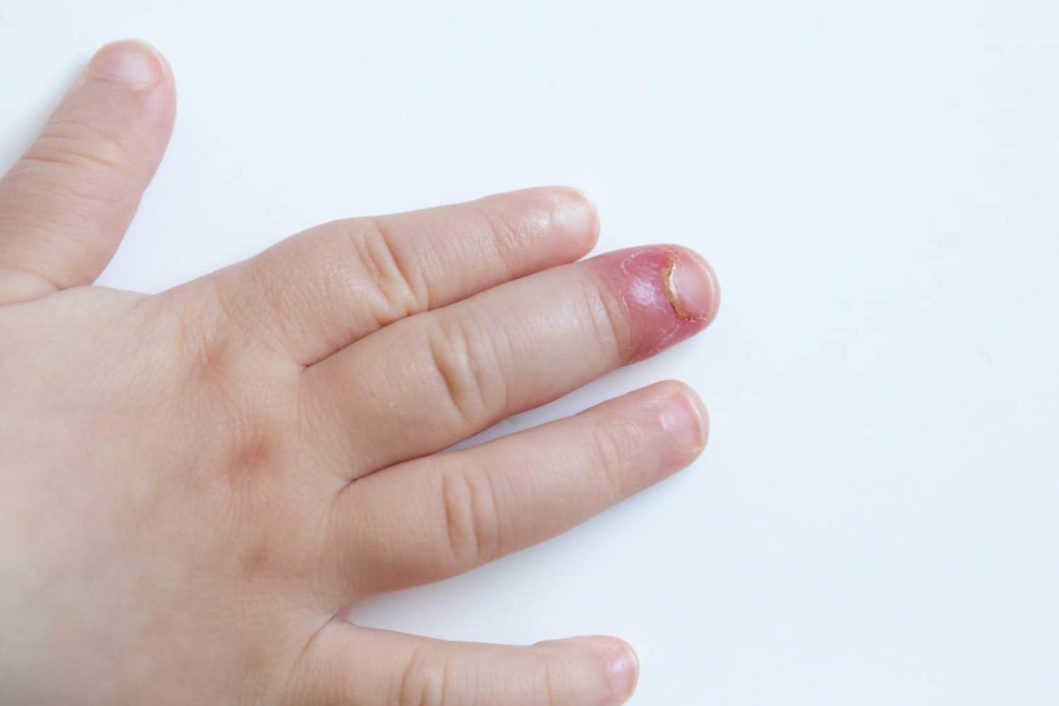 Как лечить нарыв под ногтем: нарывает палец возле ногтя на руке или ноге