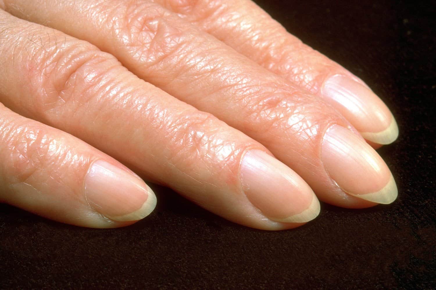 Дистрофия ногтя - лечение, причины и симптомы