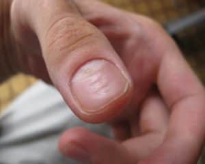 Деформация ногтей