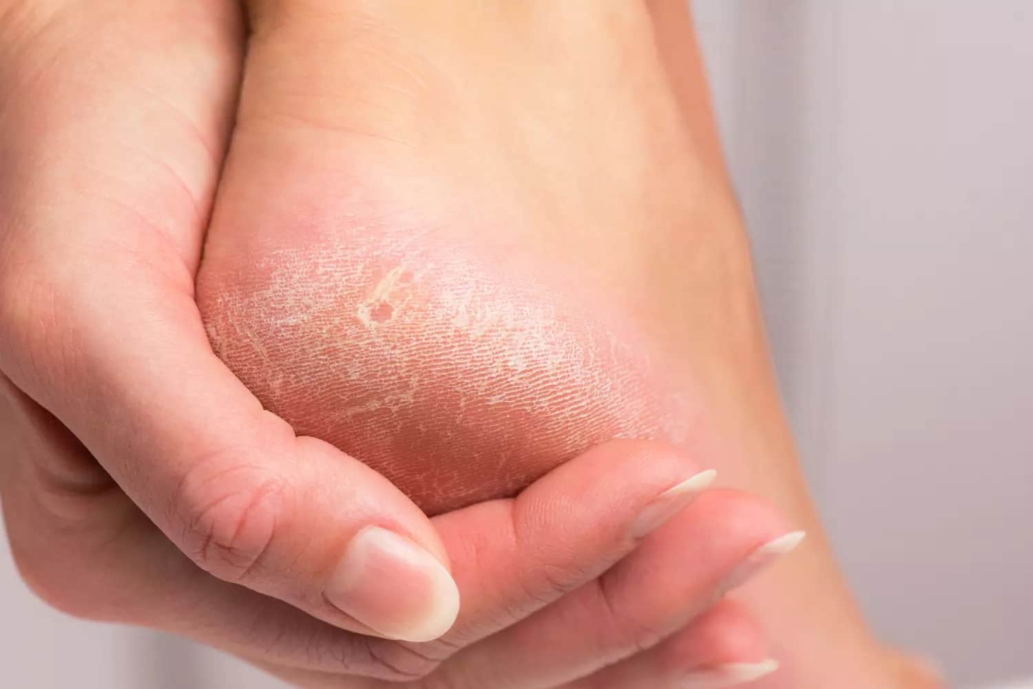 Грибок кожи – что важно знать мастеру маникюра об этом заболевании