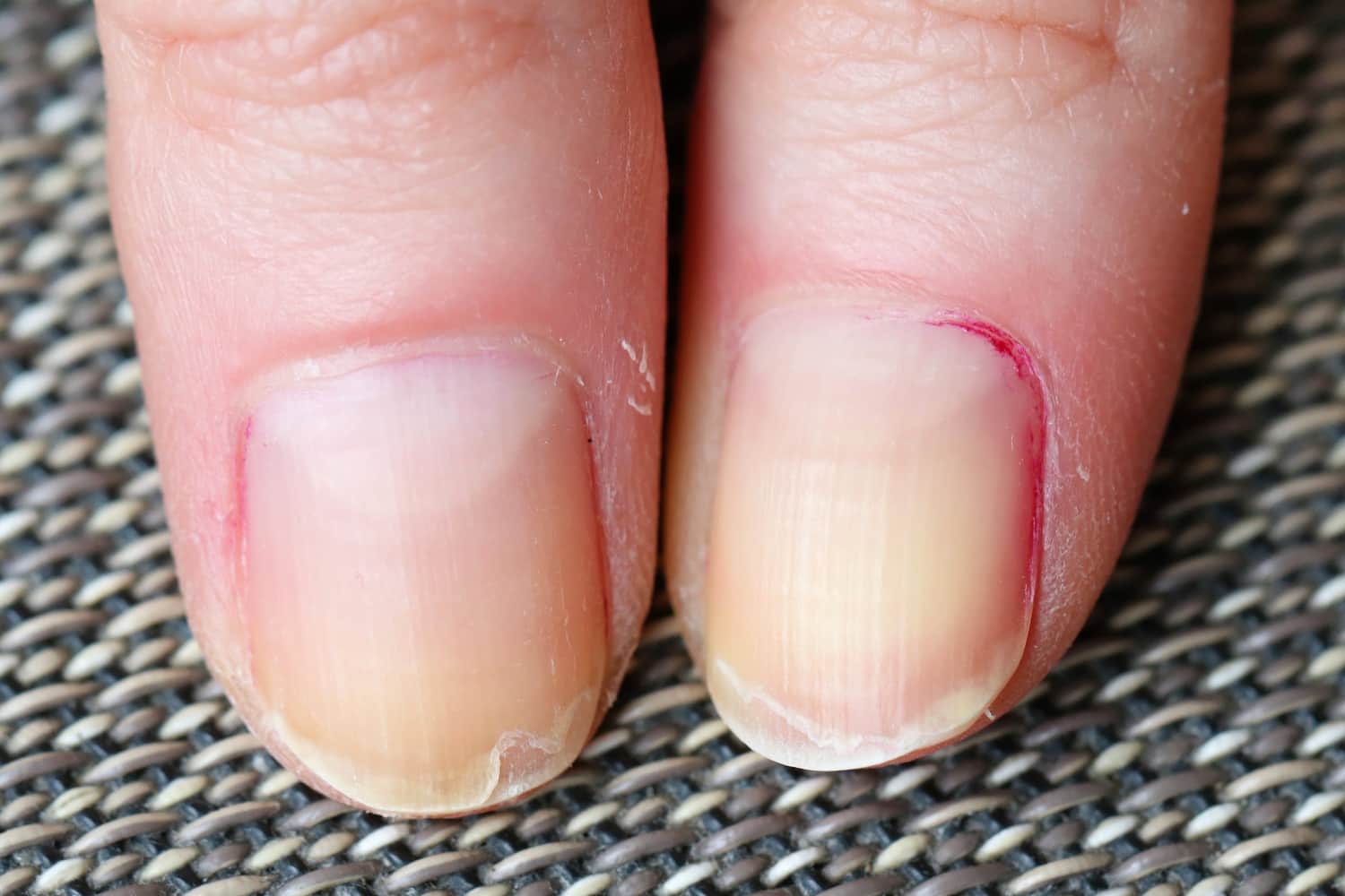 Как побороть боковые трещины на ногтях?