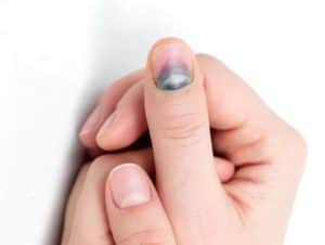 Синяки под ногтями: чем опасна гематома и как ее лечить - 17 октября, Статьи «Кубань 24»
