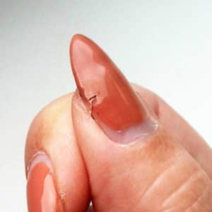 Причины образования на ногтях дефектов в виде сколов