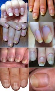 Симптомы, причины и лечение онихолизиса. Тактика при отслоении ногтя — клиника «Добробут»