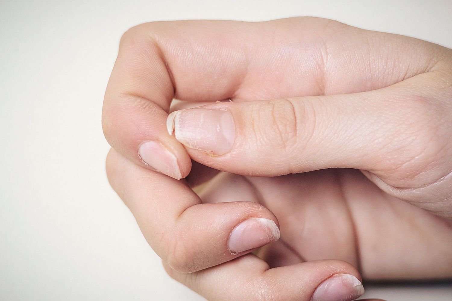 Гапалонихия: как лечить тонкие и ломкие ногти?