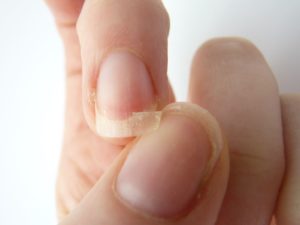Симптомы ломкости ногтей