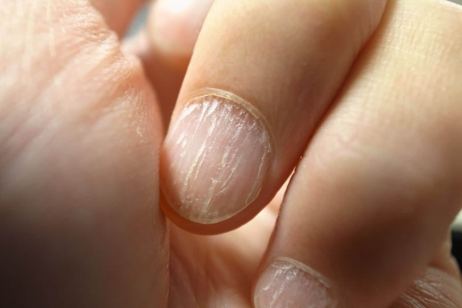 Гапалонихия ногтей – причины развития и лечение