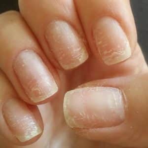 Повреждение ногтей при снятии гель-лакового покрытия