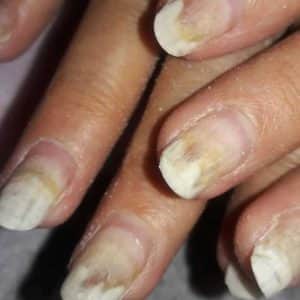 Почему болят ногти после укрепления гелем