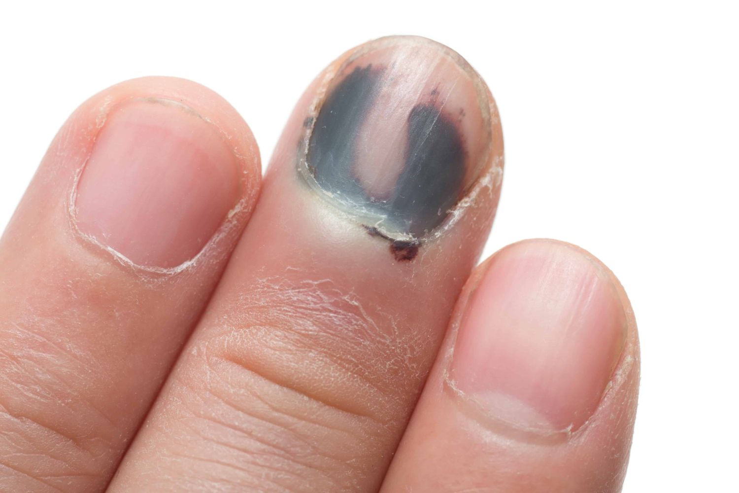 Травма ногтя на руке - причины, симптомы, цены на лечение травмы ногтя на руках в Москве