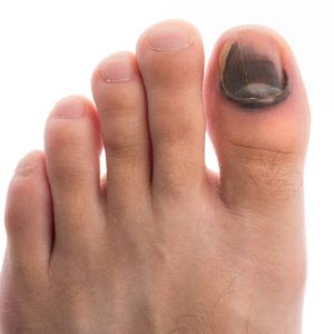 Ушиб ногтя – признаки, виды, методы лечения, осложнения и риски, профилактика