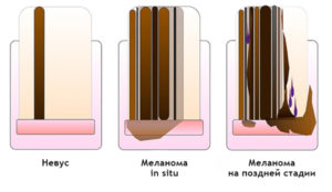 Как отличить от подногтевой гематомы?