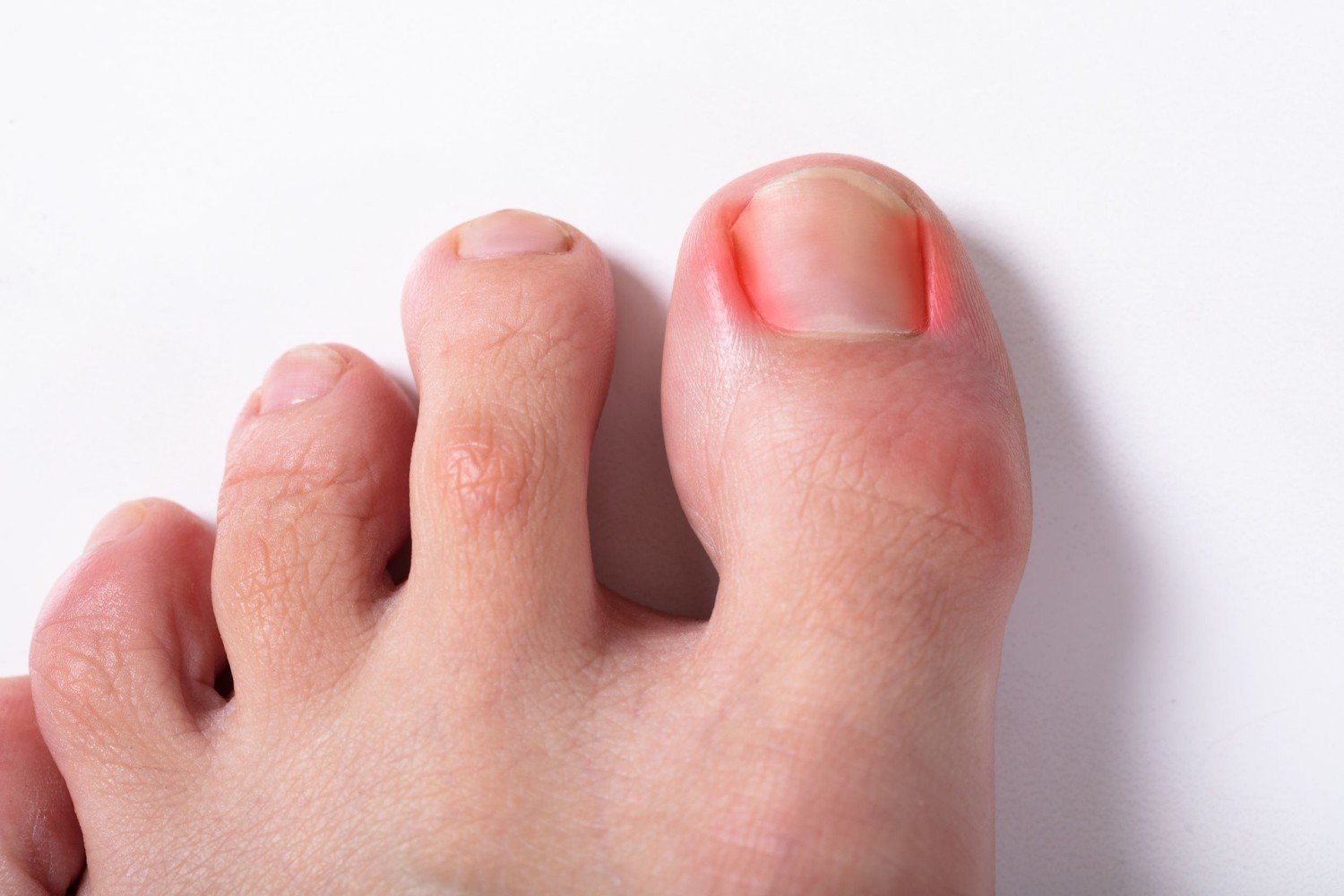 Врастание ногтей: симптомы, причины развития и способы лечения