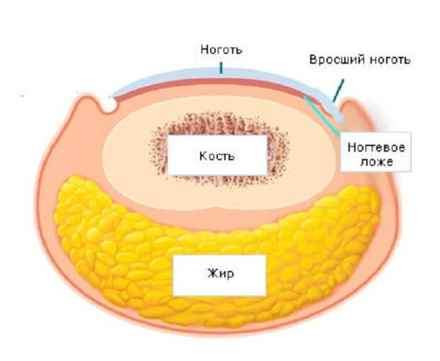 Обработка вросшего ногтя схема